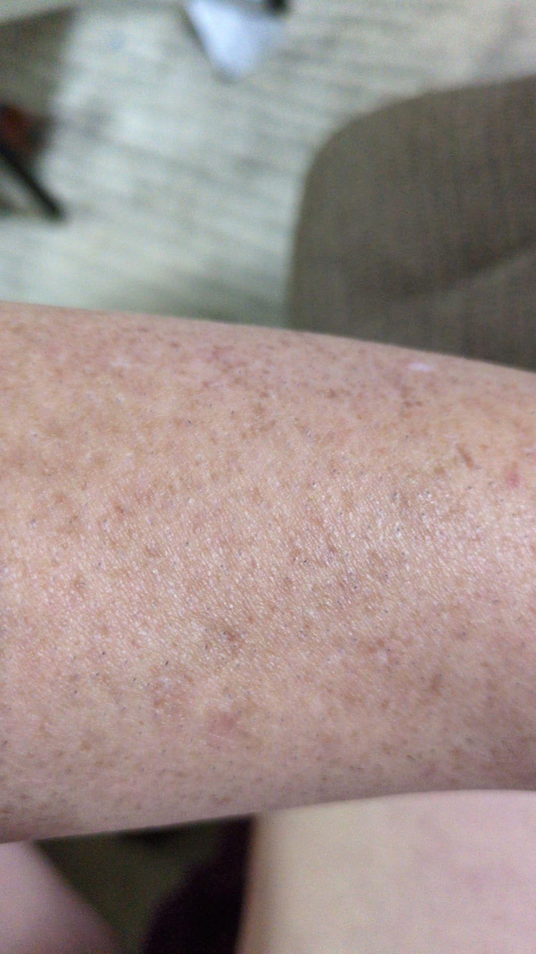 Nood Flasher Pro - Forbes Best Product 2026 - IPL Laser Hair Removal Device For At Home Use - Pain-Free, Permanent, Visible Results After First Use and Works Everywhere Hair Grows - Gloss White customer photo 1